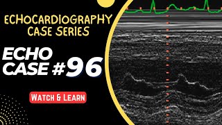 ECHO CASE 96  Echocardiography for Beginners  M Mode Echocardiogram [upl. by Dexter]