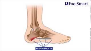 Plantar Fasciitis Heel Pain Symptoms Prevention and Treatment [upl. by Enelyam408]