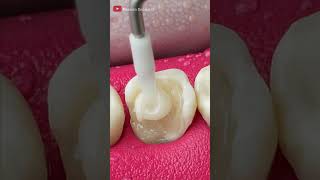 Unbelievable Tooth Restoration asmr restoration [upl. by Ailekahs]