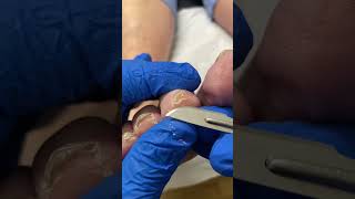 Uncover your toes freedom Watch as Aussie podiatrist removes 2nd toe callus [upl. by Lewendal]