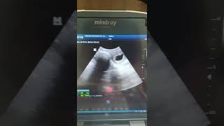 Blighted ovum Ultrasound ultrasound shortvideo [upl. by Ahsyad403]