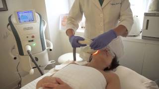 IPL Photofacial with Lumenis M22 at Trifecta Med Spa [upl. by Nonrev]