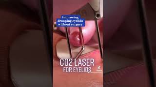 How to Rejuvenate Your Eyes  CO2 Laser Treatment [upl. by Kopans]