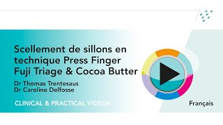 Scellement de sillons en technique Press Finger Fuji Triage amp Cocoa Butter [upl. by Schalles]