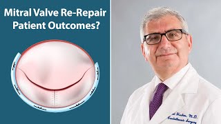 Mitral Valve ReRepair Outcomes with Dr Sabet Hashim [upl. by Coleman]