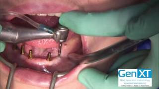 Lower Full Arch Flapless Dental Implant Surgery with GenXT Compression Implants [upl. by Ettevahs]