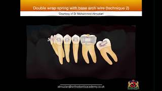 Uprighting impacted molars [upl. by Daraj]