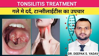 TONSILITIS CAUSES SINGS amp SYMPTOMS TREATMENT tonsillitis treatmentoftonsilitis [upl. by Htor]