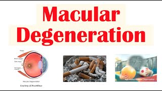 Macular Degeneration  Wet vs Dry  Risk Factors Pathophysiology Symptoms Diagnosis Treatment [upl. by Zielsdorf]