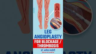 Opening Blocked arteries of Legs with Balloon Angioplasty youtubeshort legAngioplasty shortsfeed [upl. by Niroc]