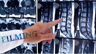 MRI LS Spine filming L5 numbering without spinogram [upl. by Hatti]