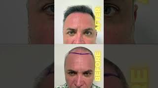 Before and After in Care4Hair  Hair Implant [upl. by Attlee]