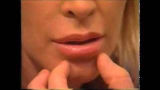 Dr Randal Haworth  Lip Enhancement via VY Plasty [upl. by Nehpets]