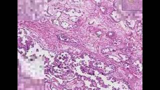 Histopathology TestisEmbryonal carcinoma [upl. by Lonny219]