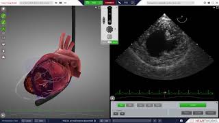 HeartWorks Left Ventricular Anterior Wall Motion Abnormality [upl. by Bayer]