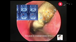 Endoscopic removal of nasal foreign body almost into a fossil [upl. by Booma]