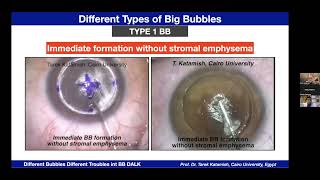 To The Wonderland  Different bubbles different troubles in Big Bubble DALK  ProfTarek Katamish [upl. by Nezam]