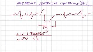 EKG 310  Premature Ventricular Contraction PVC [upl. by Kenwrick]