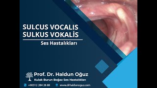 Sulcus Vocalis  Sulkus Vokalis [upl. by Amatruda]