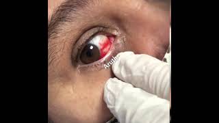 Hiposfagma Hemorragia Subconjuntival  Hyposphagma Subconjunctival Hemorrhages [upl. by Nigrom]