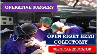 OPEN RIGHT HEMICOLECTOMY STEP BY STEP OPERATIVE SURGERY [upl. by Vitalis]