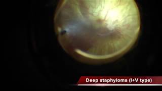 Myopic Foveoschisis with deep staphyloma [upl. by Kenon293]