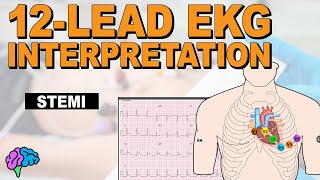 Recognize ST Elevation Myocardial Infarction STEMI on 12lead EKG [upl. by Tayib]