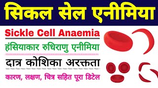 सिकल सेल एनीमिया  sickle cell anemia in hindi  sickle cell anemia class 12 biology ScienceSK [upl. by Skerl]