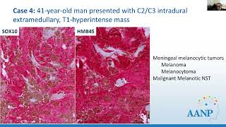 AANP Teaching Rounds  October 23 2024  Hereditary Tumor Syndromes Associated with CNSPNS Tumors [upl. by Otreblada]