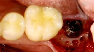 Safe implantation using Dentium short implant [upl. by Eckardt435]