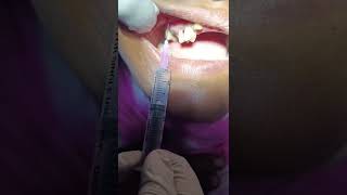 Local Infiltration anesthesia LIA  Upper Premolar  DrteethSohel semapur [upl. by Olive825]