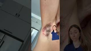 Deodorant Rash Gone Wrong  Must See [upl. by Celinda257]