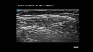 Thigh Ultrasound Lateral Femoral Cutaneous Nerve LFCN Block for Meralgia Parasthetica [upl. by Revilo]