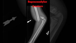 Supracondylar Fracture shorts fracture supracondylarfracture elbowxray radiology [upl. by Rabkin]