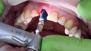 Stomatologie ChisinauBotanicaTerraDent Moldova Implant dentar imediat si coroana provizorie [upl. by Shari765]