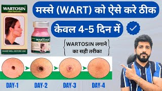 WARTOSIN  MASSE WART KO AISE HATAYE  WARTOSIN USE KARNE KA SAHI TREEKA  WART REMOVER [upl. by Yanttirb]