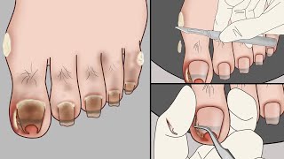 ASMR Ingrown Toenail Removal Treatment AnimationStrong Satisfaction  Mengs Stop Motion [upl. by Arymas409]