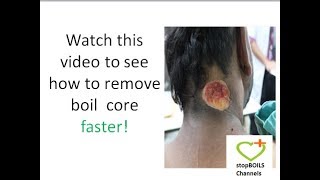 How to get the core out of a boil a video on how to get the head out of a boil at home watch now [upl. by Alaehcim]