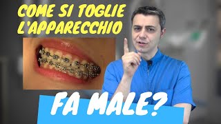 Fa male togliere lapparecchio fisso video operativo [upl. by Seravaj230]