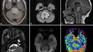 Posterior fossa mass causing moderate hydrocephalus  Medulloblastoma fits  Papilledema [upl. by Hermione960]