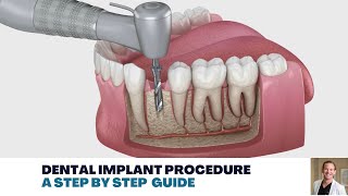 Dental Implant Procedure A Step by Step Guide [upl. by Adekahs]