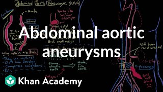 Abdominal aortic aneurysms  Circulatory System and Disease  NCLEXRN  Khan Academy [upl. by Bender]