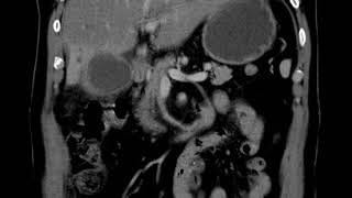 HBP C1 Perforated acute cholecystitis with liver abscess [upl. by Anal537]