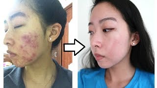 How I Cleared My Acne with ONE Product NO ACCUTANE [upl. by Attenahs]