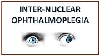 Internuclear Ophthalmoplegia  INO  WEBINO Syndrome  One and Half Syndrome [upl. by Mirth]