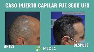 🙋‍‍CASO REAL de Injerto Capilar  3500 UFS  Resultados increíbles 👏‍‍ [upl. by Oicinoid163]