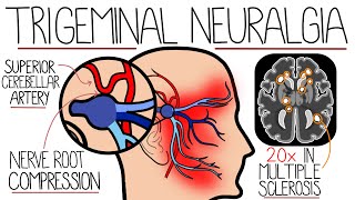 Understanding Trigeminal Neuralgia [upl. by Retsub]