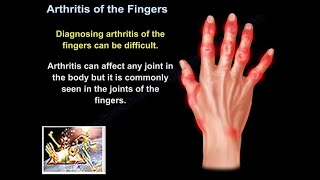 Arthritis Of The Fingers  Everything You Need To Know  Dr Nabil Ebraheim [upl. by Namor]