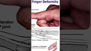 mallet finger deformitythephysiodoctoranatomyphysiotharapisthumananatomymotivationbiology [upl. by Lightman]