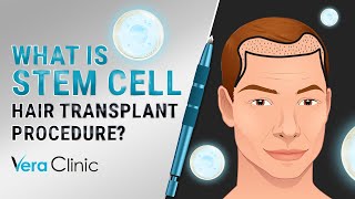 What Is Stem Cell hairtransplant Procedure stemcelltransplant [upl. by Curry]